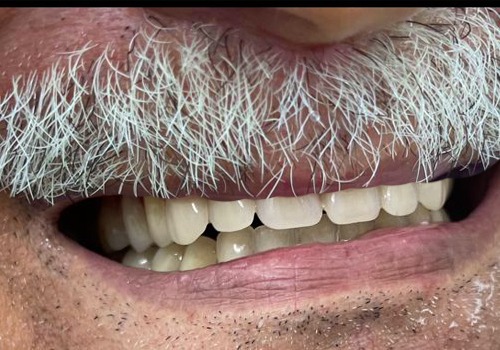 نتائج قبل وبعد علاج الأسنان - شفا