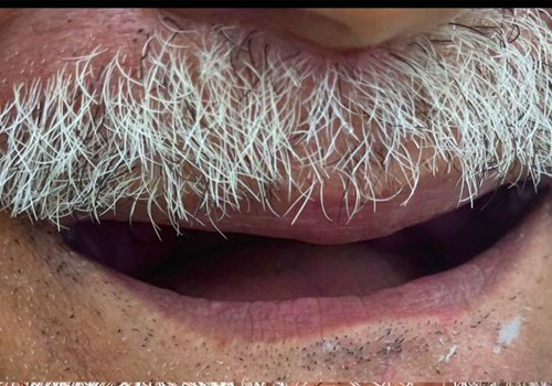 نتائج قبل وبعد علاج الأسنان - شفا